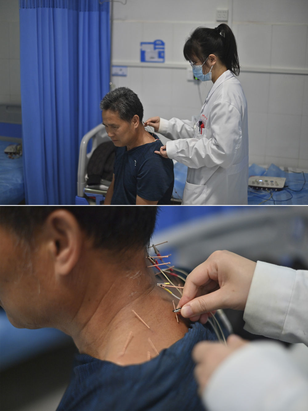 在广西柳州市融安县泗顶镇卫生院，医生蓝天彩为村民进行针灸治疗（4月29日摄）。今年23岁的蓝天彩，大学毕业后选择到乡镇医院工作。